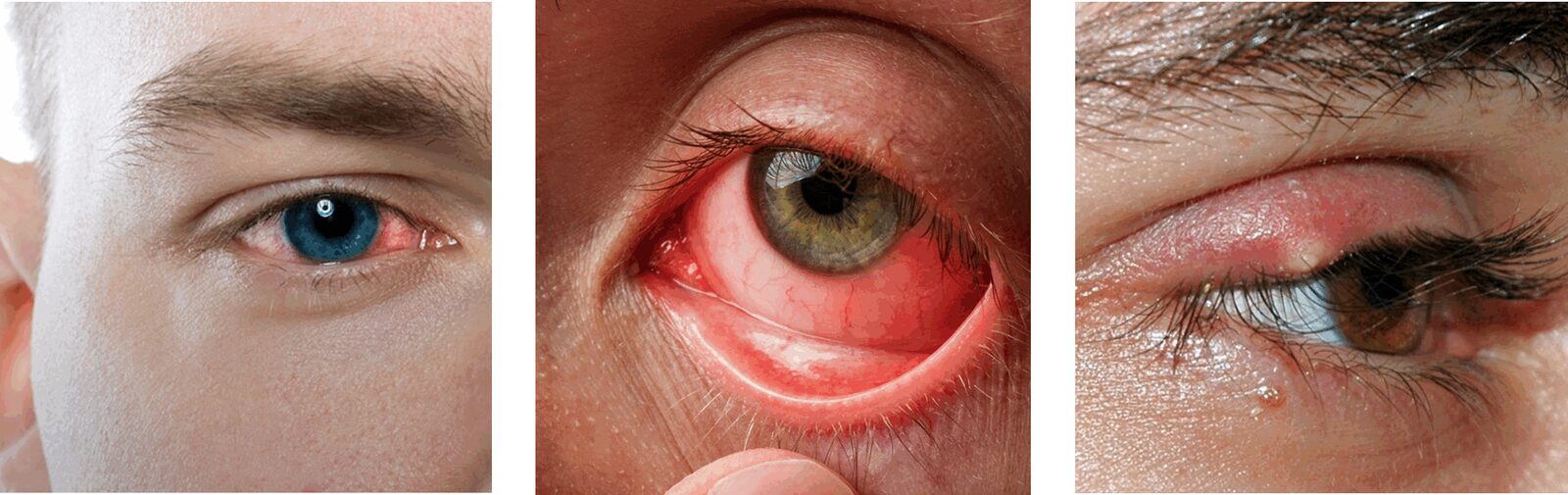 photo - eye infection